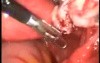 Ovarian Pregnancy - Unusual Location Of Ectopic Pregnancy