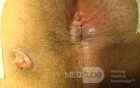 Fistula in Ano (1 of 7)