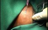 Neck Space Infections- Surgical Drainage Of The Abscess