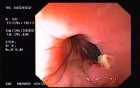 Full Colonoscopy (1 of 4)
