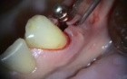 Implant Microsurgery: Periimplant Repair of Implant Overdenture Abutment