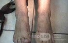 Extensive Acanthosis Nigricans due to rectal carcinoma (4 of 7)