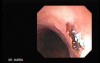 Traqueostomy Fistula (4 of 5)