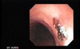 Traqueostomy Fistula (4 of 5)