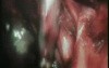 Difficult Laparoscopic Cholecystectomy