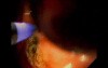 Endoscopy of Mallory Weiss Tear - Coagulation by Use of Argon Plasma Coagulator