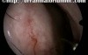 Little's Area - Abnormal Blood Vessels