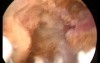 Histeroscopic resection of adenomyosis