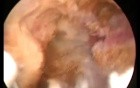 Histeroscopic resection of adenomyosis