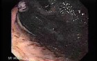 Dieulafoy´s Lesion (Exulceratio Simplex) (9 of 9)