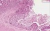 Adenocarcinoma - Histopathology - Colon