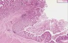 Adenocarcinoma - Histopathology - Colon