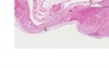 Duodenum- Peptic Ulcer