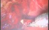 Laparoscopic Cholecystectomy - Coagulation Of Bleeding Vessels