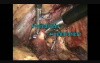 Laparoscopic Left Nephrectomy