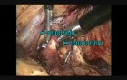 Laparoscopic Left Nephrectomy