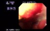 Gastric Adenocarcinoma - Obstruction 5