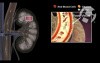 Nephropathy