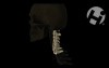 Fractured C5 Vertebral Body