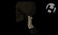 Fractured C5 Vertebral Body
