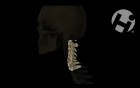 Fractured C5 Vertebral Body