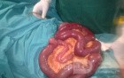 Meckel's Diverticulum