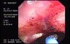Radiation Proctosigmoiditis (7 of 14)