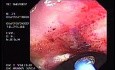 Radiation Proctosigmoiditis (7 of 14)