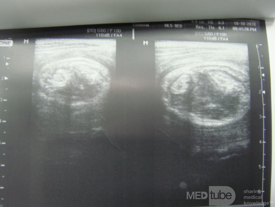 Intussusception on US