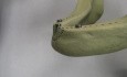 Rationale For Ridge Augmentation - Model Demonstration