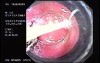 Banding of Esophageal Varices - Suction
