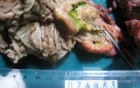 Synchronous Cancers, Familial Adenomatous Polyposis (31 of 36)