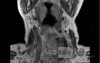 Esophageal Squamous Cell Carcinoma of the the upper third of the Esophagus that invades the subglotic (8 of 8)