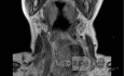 Esophageal Squamous Cell Carcinoma of the the upper third of the Esophagus that invades the subglotic (8 of 8)