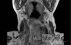 Esophageal Squamous Cell Carcinoma of the the upper third of the Esophagus that invades the subglotic (8 of 8)