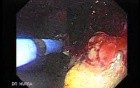 Recurrent Gastric Cancer after Gastrectomy Billroth II (5 of 6)