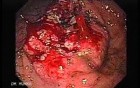 Adenocarcinoma of the Antrum (4 of 5)