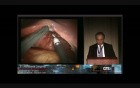 Single-Site Robotic Surgery: The Greek Experience