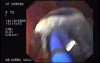 Esophageal Achalasia  (8 of 16)