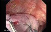 Colonoscopic Polypectomy (14 of 23)