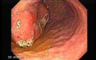Gastrointestinal Stromal Tumor - GIST (5 of 13)