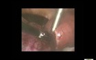 Laparoscopic Excision Of A Pedunculated Fibroid Using Bipolar