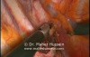 Laparoscopic Right Sympathectomy