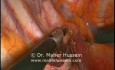Laparoscopic Right Sympathectomy