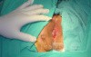 Fistula in Ano (4 of 7)