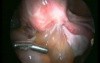 Laparoscopic Rectovaginal Endometriotic Nodule Excision