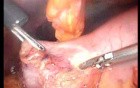 Gastrointestinal Stromal Tumor - GIST (22 of 65)