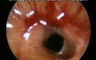 Subglottic Ulcers with Cricotracheal Stenosis - Infection