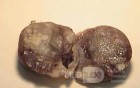 Plastic Linitis with bilateral Krukenberg´s tumor (6 of 13)