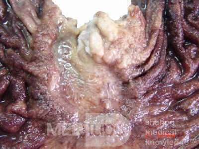 Adenocarcinoma of the cardias and gastric fundus with signet-ring cells (15 of 25)